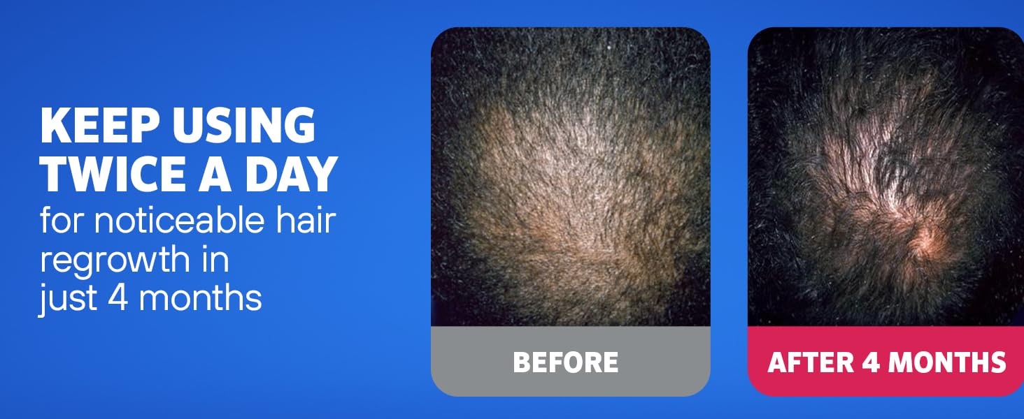 Rogaine Men's Minoxidil Hair Regrowth Foam and Solution Use 2x per day